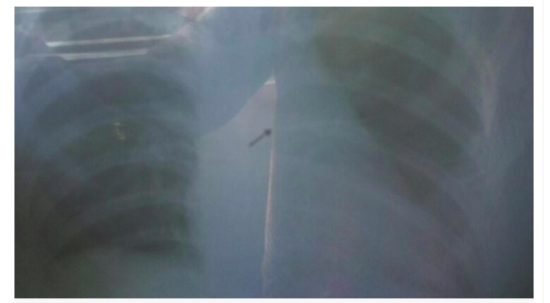 Tak sengaja telan jarum saat memperbaiki hijabnya, anak sekolah harus dioperasi 17 hari kemudian