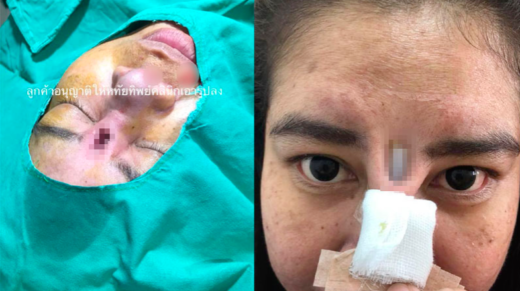 Ngeri: Implan hidung gagal, untung ada klinik yang mau benerin gratis